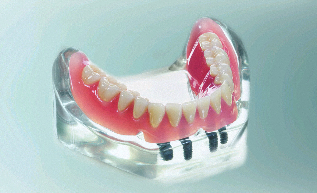 Verankerungen für herausnehmbaren Zahnersatz